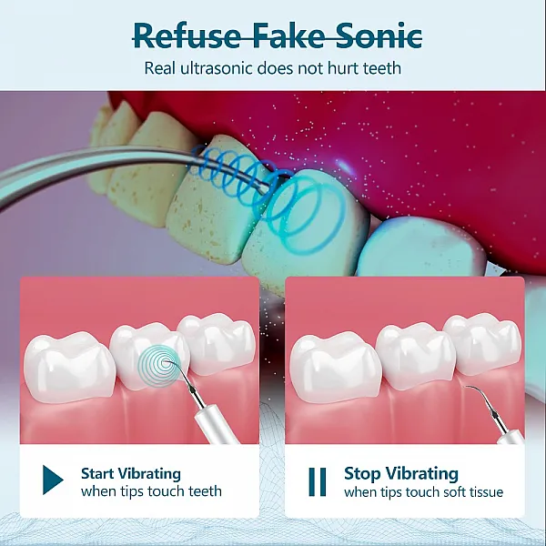 Ultrasonic Dental Calculus Remover for Dental Cleaning